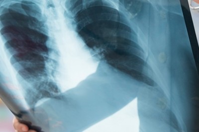 Prefeitura de Goiânia amplia e moderniza diagnóstico precoce de doenças pulmonares